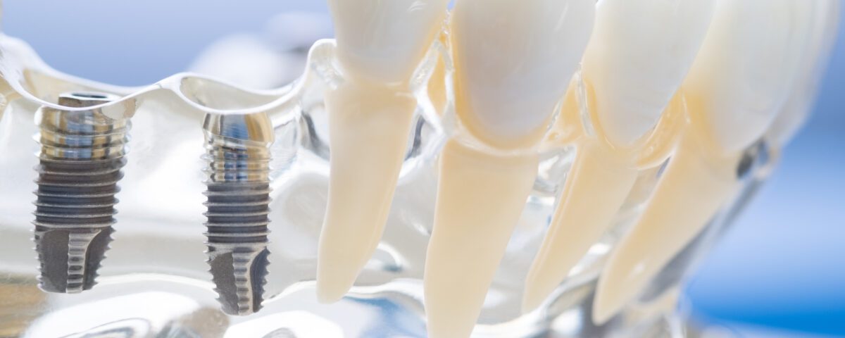 Benefits of Modern Dental Implants