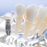 Benefits of Modern Dental Implants